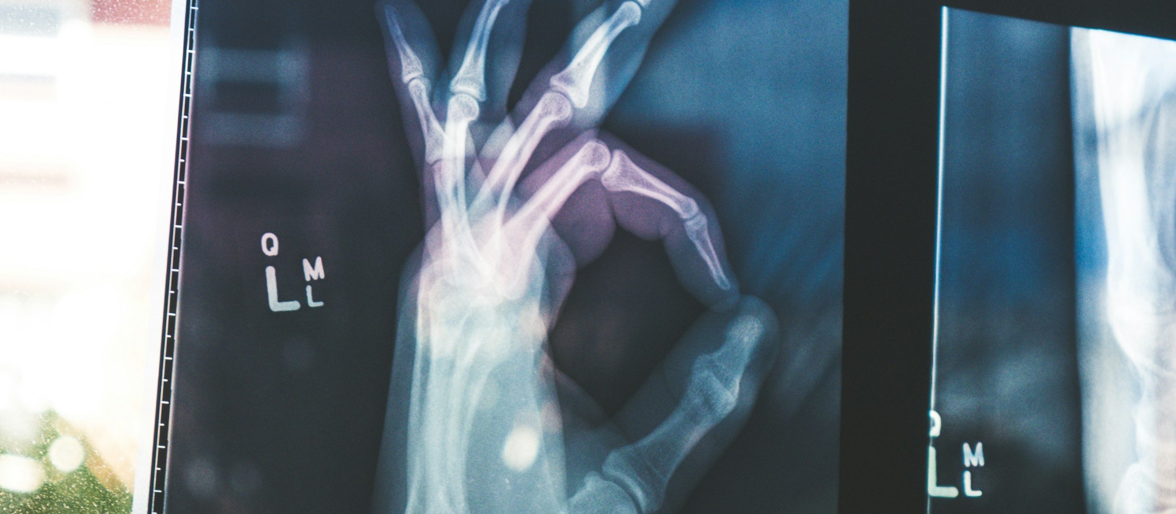 X-Ray