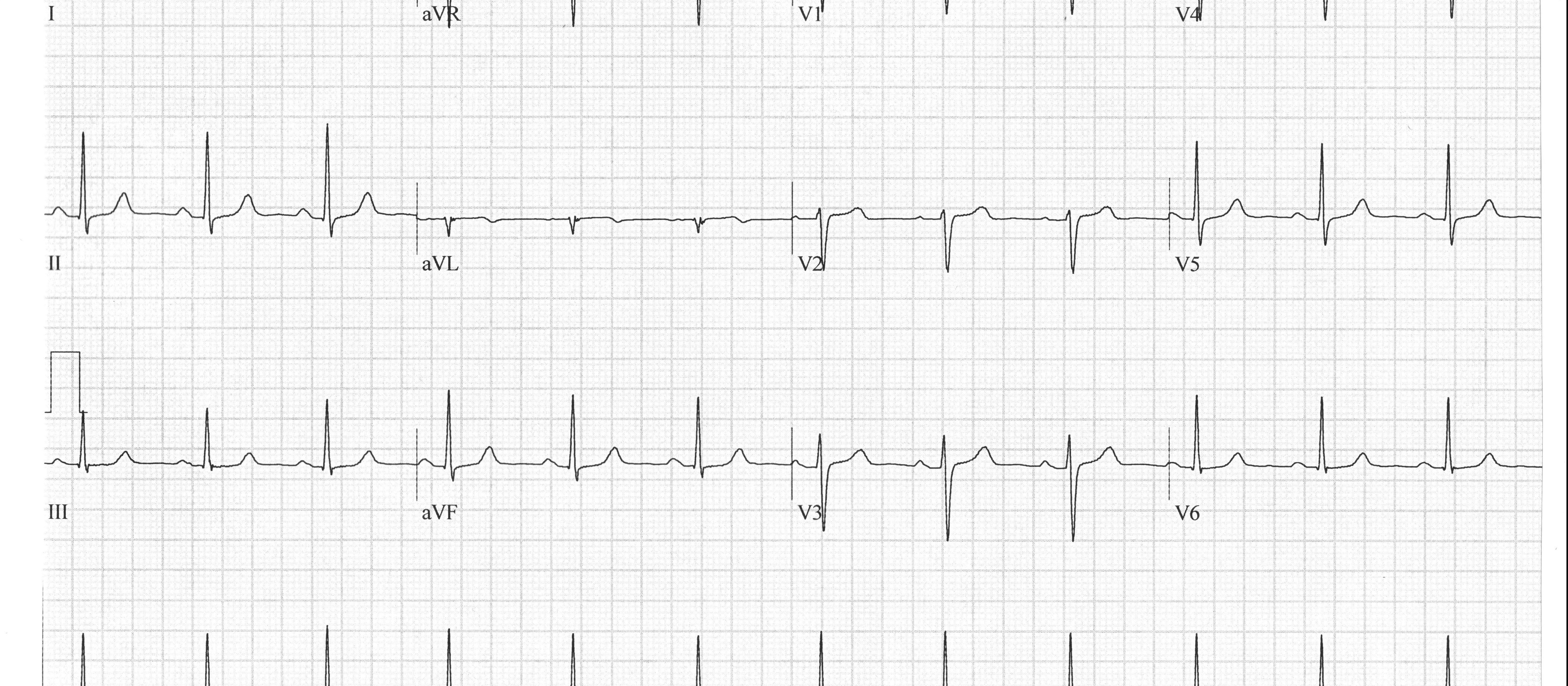 Heartbeat