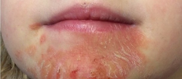 Acrodermatitis enteropathica Case 2