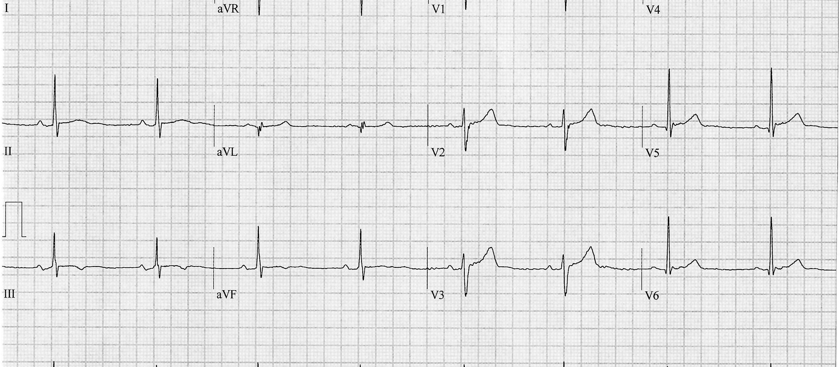 Heartbeat-ECG-28-Aug-2024