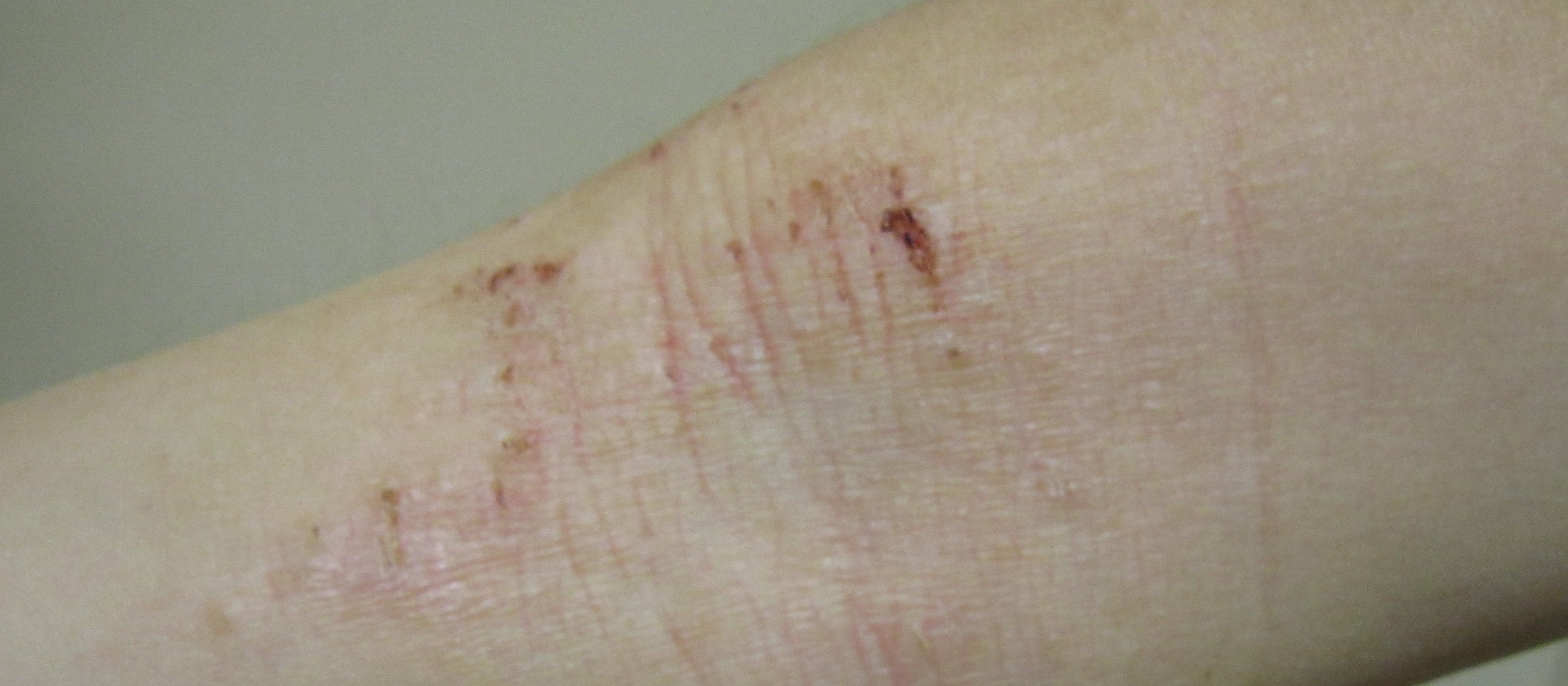 Eczema