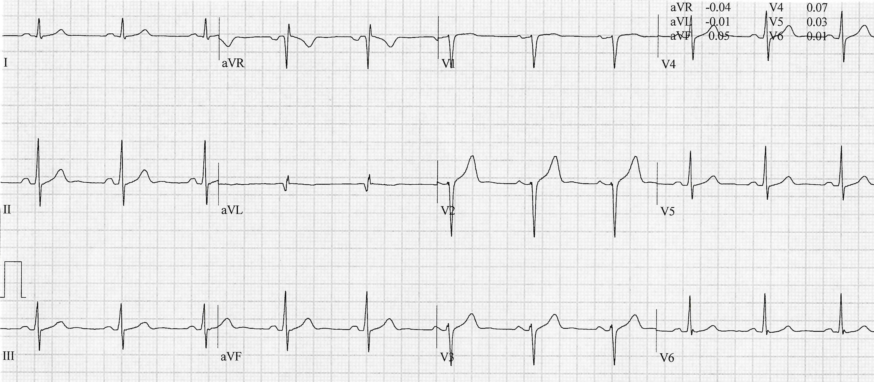 Heartbeat ECG 20 Nov 2024