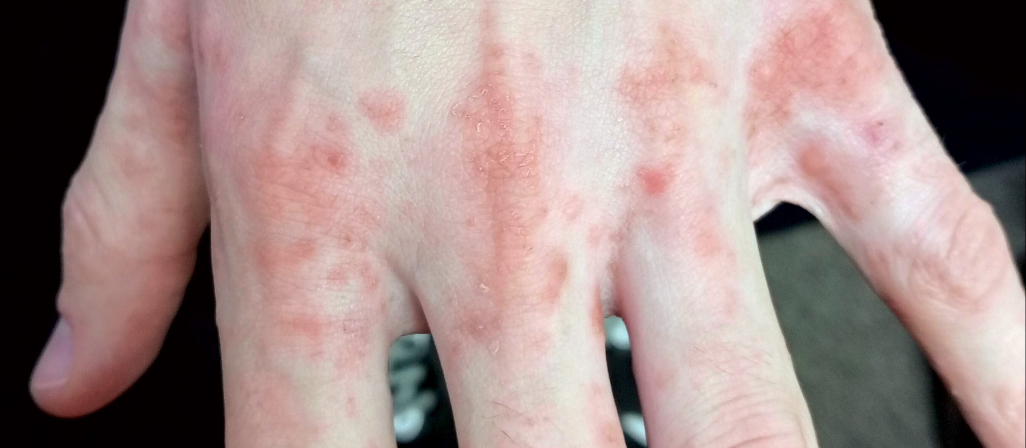 Fig 1 Scabies