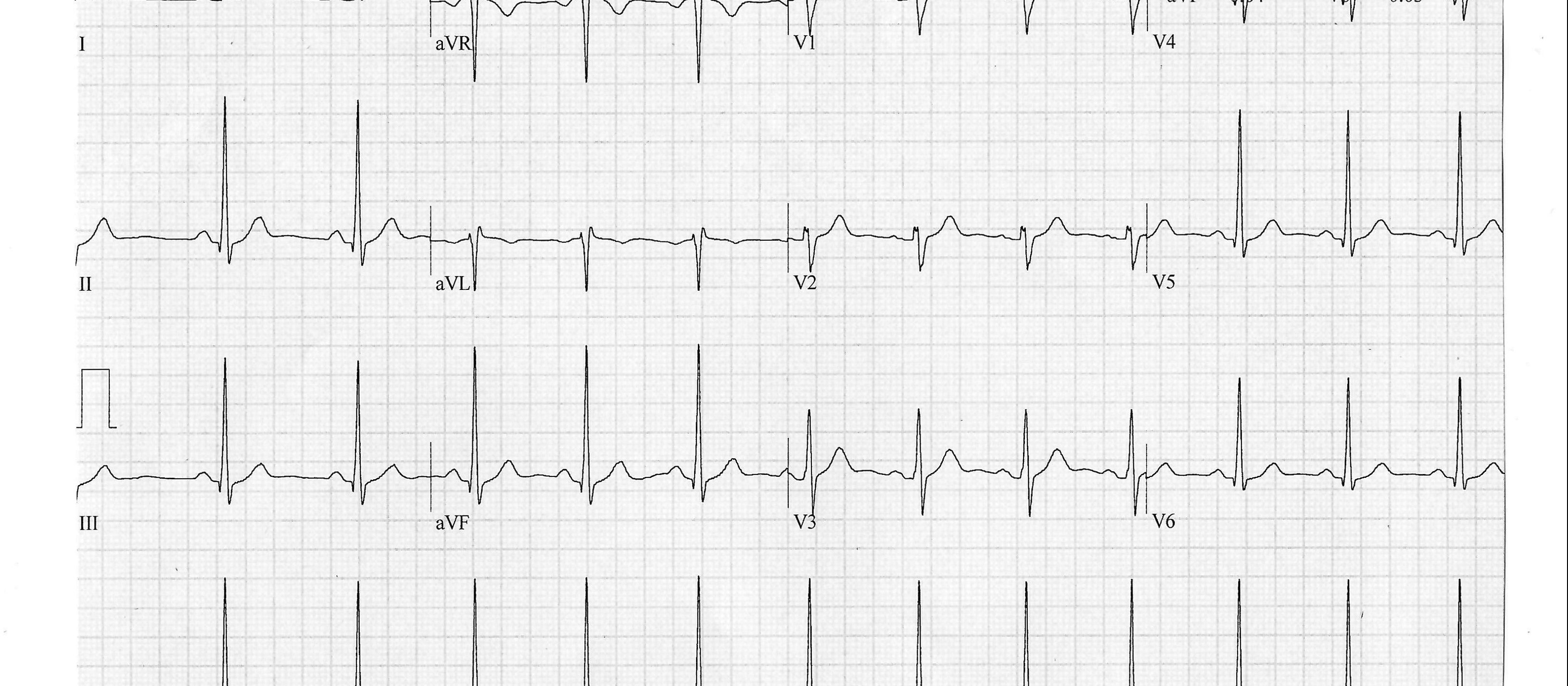 Heartbeat-ECG-Feb