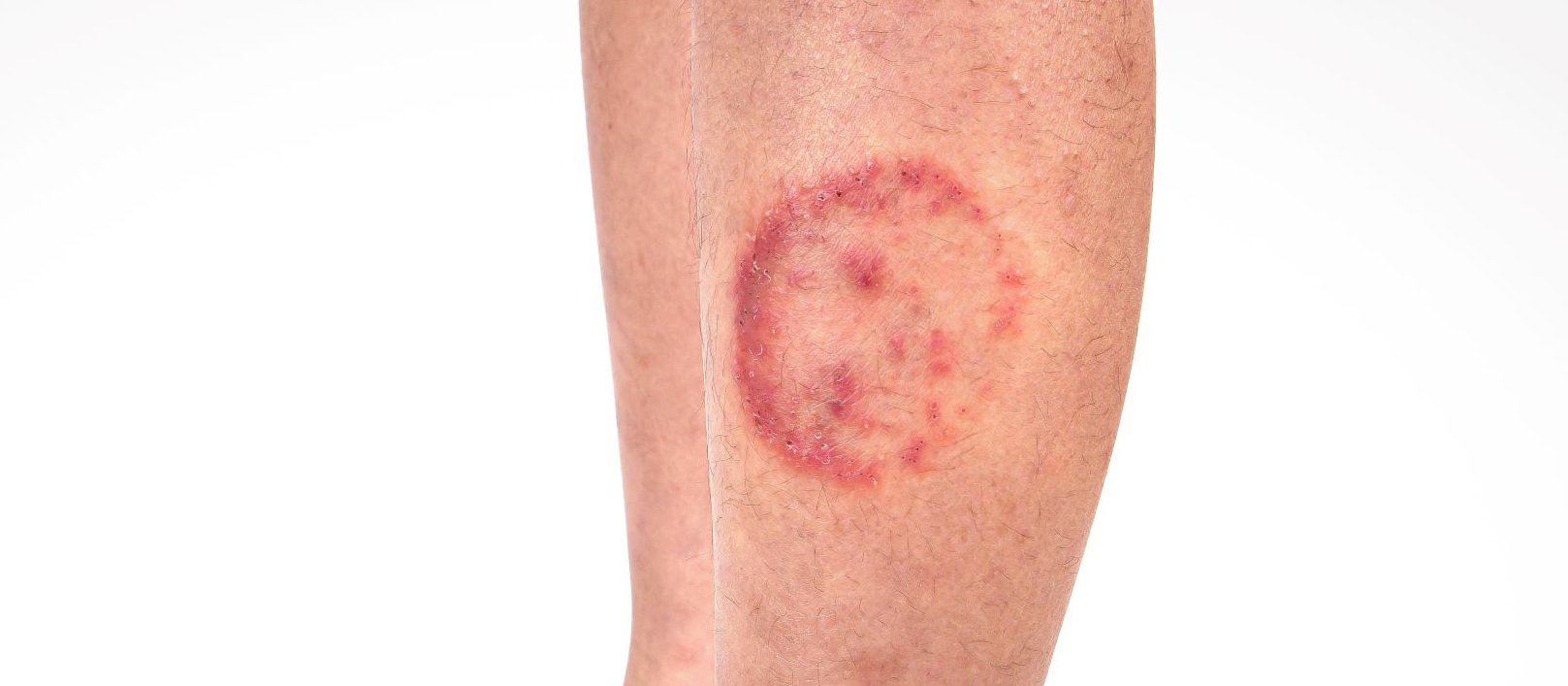 Ringworm infection Tinea corporis