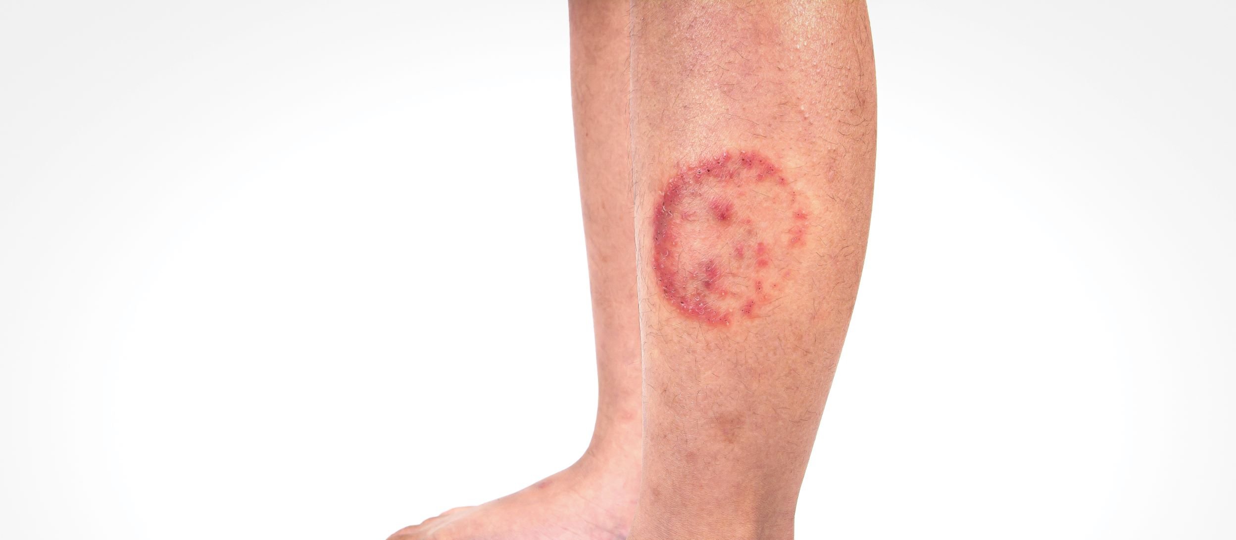 Ringworm-infection-Tinea-corporis