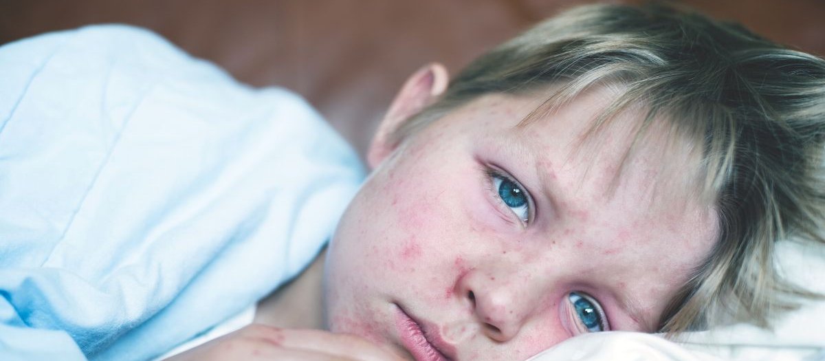 Boy with measles