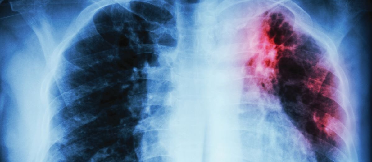 Pulmonary Tuberculosis CR iStock