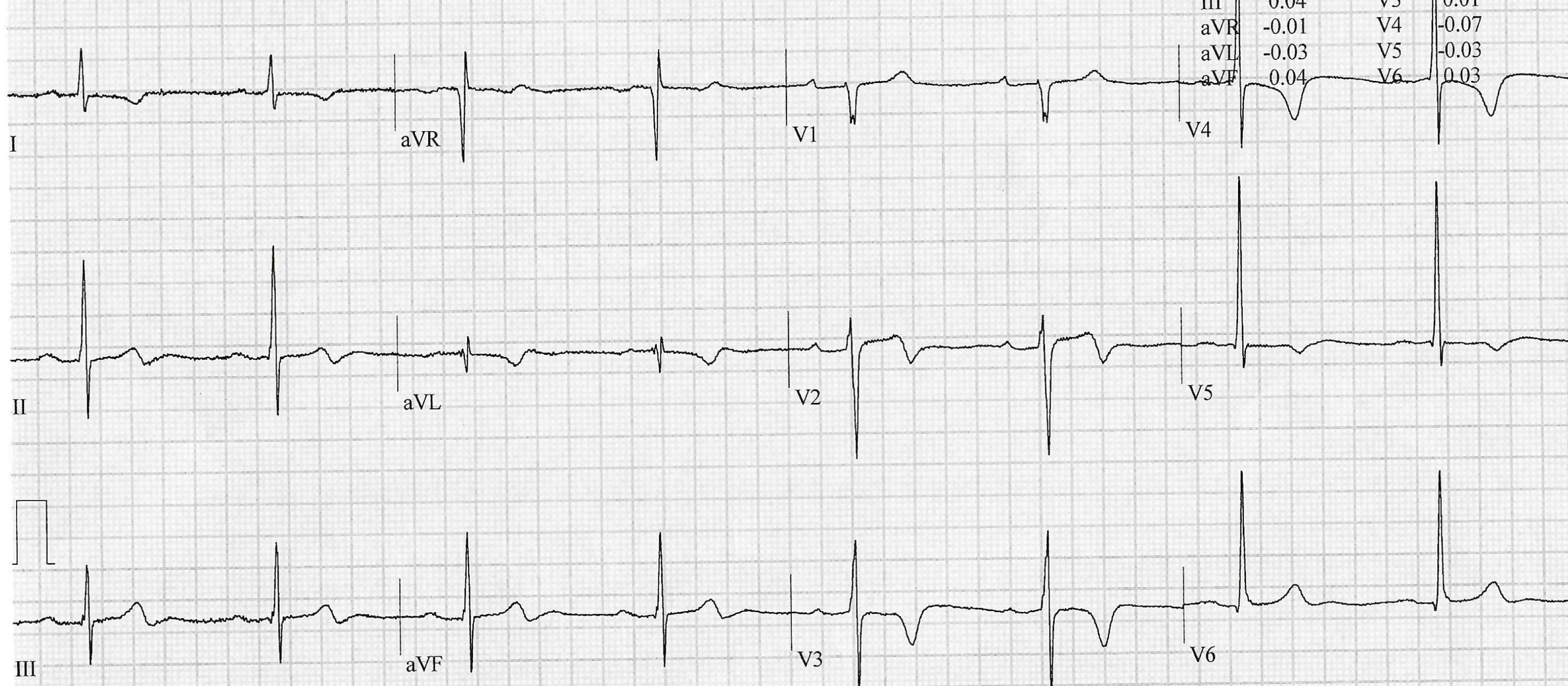 ECG Apr 2025