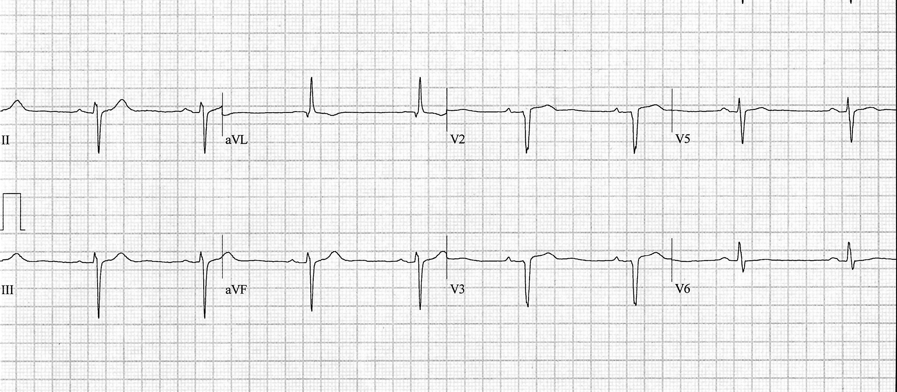 Heartbeat-ECG-Jun-2025