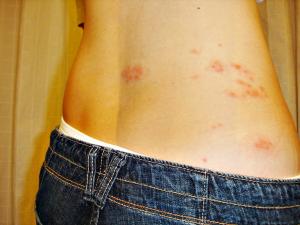 herpes_zoster_shingles