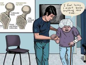 Frazer - osteoporosis