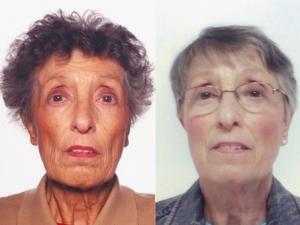  The Patient's Facial Appearance at Presentation versus after Treatment. Facial appearance at presentation (left), showing pigmentation, and after treatment (right).© 2005 Petros Perros