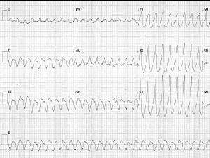 Heartbeat-ECG-260918