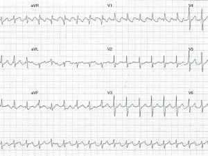 ECG heartbeat