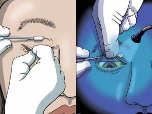 Fraser - corneal abrasions, eye injuries