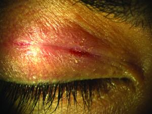 Lid dermatitis