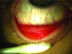 Eye