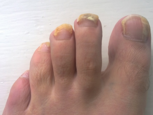 Patient's foot with a fungal nail infection 10 weeks after oral treatment