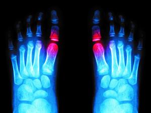 Foot X-Ray