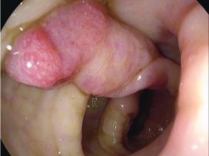  An advanced adenoma (1.5cm diameter) before polypectomy