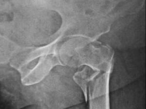 fractured hip