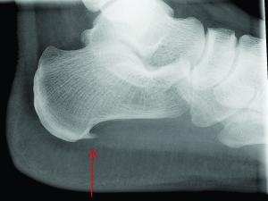 Plantar fasciopathy, sports medicine, injury