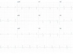 Heartbeat ECG 03032021
