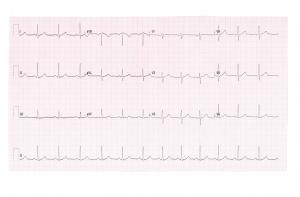 ECG