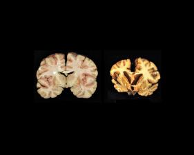 Sports-medicine_brain
