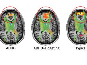 ADHD Brain MRI scan