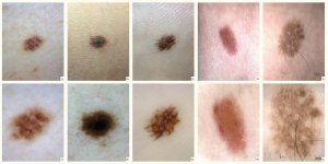 Dermatoscopic examination 1