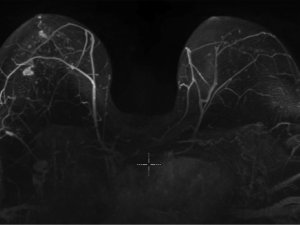 Abbreviated breast MRI showing a multifocal invasive lobular cancer in the left breast