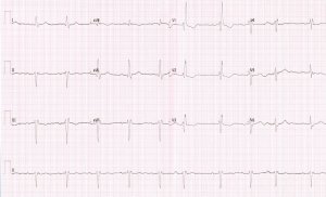 The term “trifascicular block” is a misnomer used to describe a combination of a right bundle branch block, an anterior (or posterior) left fascicular block and a first-degree atrioventricular block (a prolonged PR interval) 