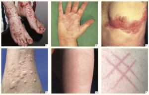 Adverse cutaneous reactions following COVID-19 vaccination 1-6