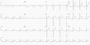 Heartbeat ECG