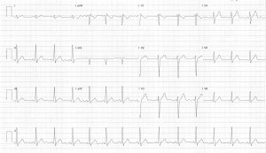 ECG