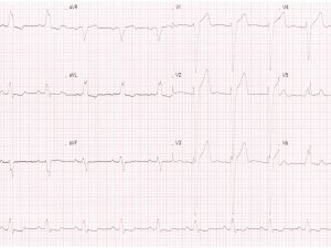Heartbeat ECG 