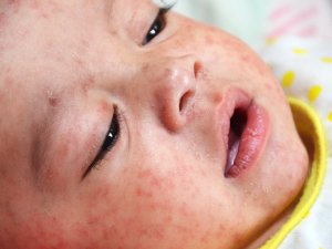 Baby with measles by Jim Goodson