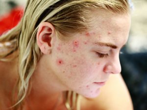 Young people acne