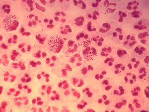 Gonorrhoea
