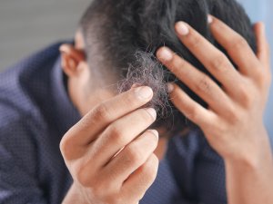 Hair Loss