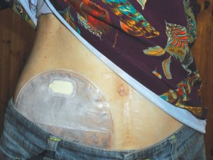 Ileostomy stoma bag 