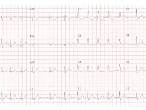 ECG
