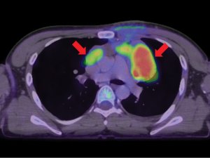 Fused PET and CT images