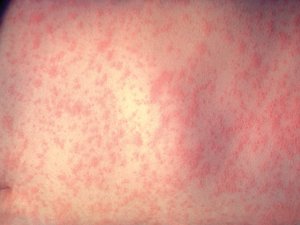 Figure 1. Characteristic maculopapular rash