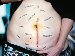 Surgical scar words CR Alexander Grey on Unsplash