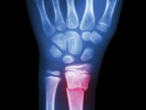 Broken wrist [Image: Stockdevil on iStock]