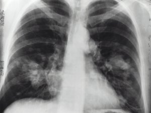 Chest X-Ray 