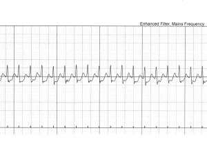 ECG